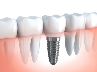 Full Mouth Implant Restoration Benefits Explained